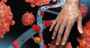 Dominica to continue monitoring the developments regarding the Mpox virus